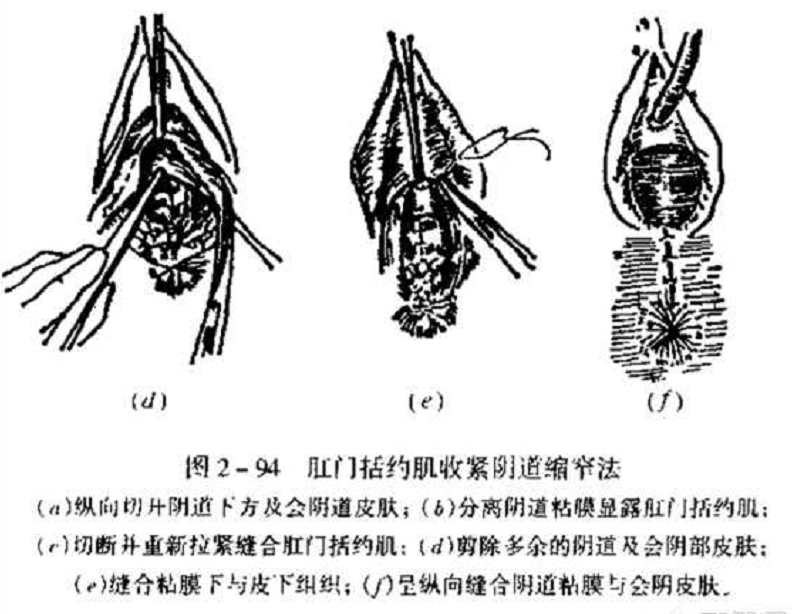 关于阴道整形的探讨