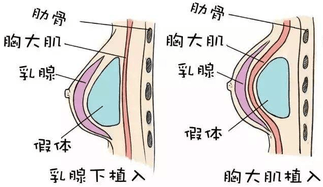 假体隆胸