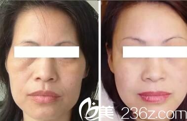 眉间注射除皱，重塑青春容颜的新选择