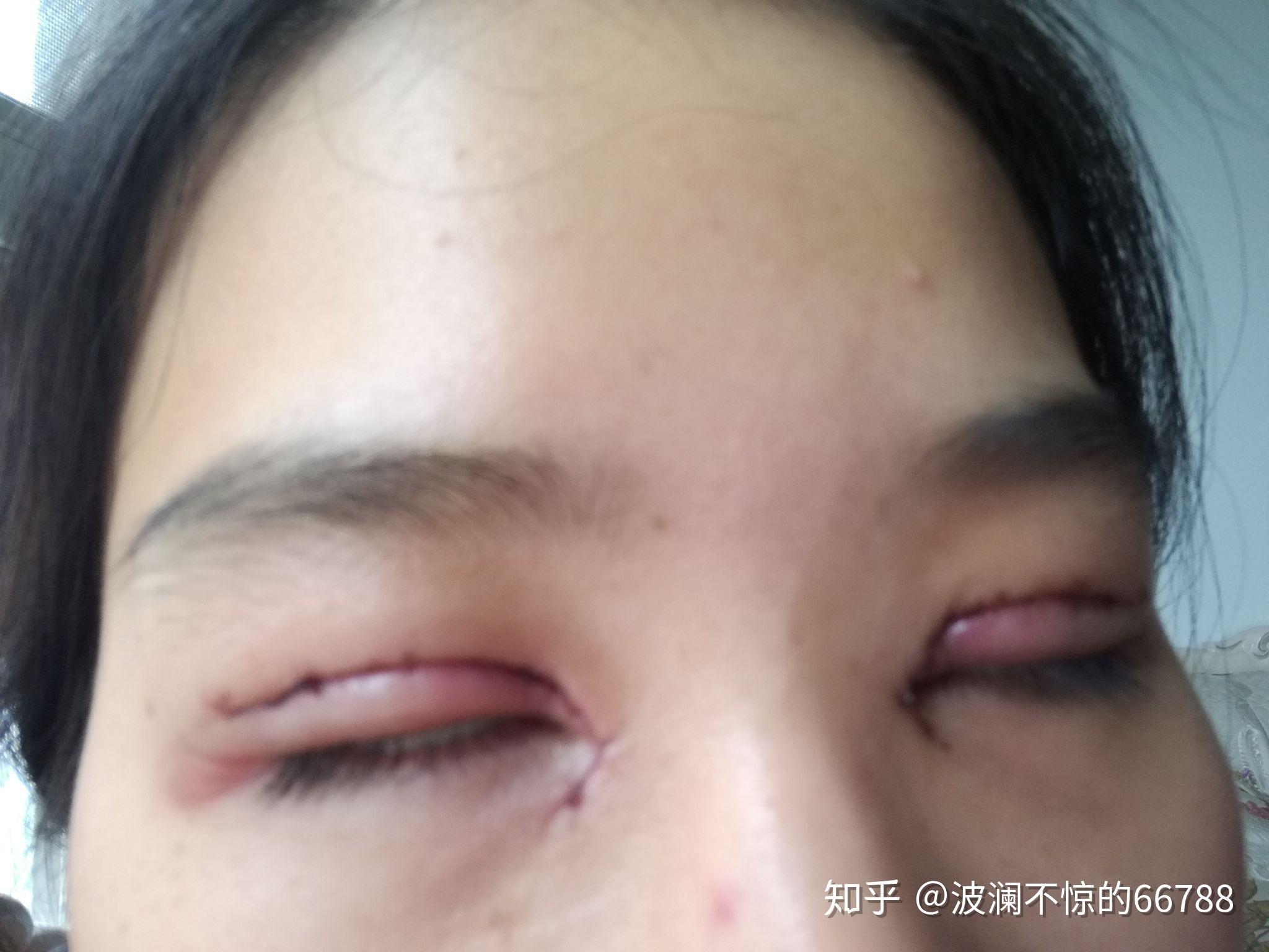 双眼皮全切过程，从决策到恢复的全过程解析