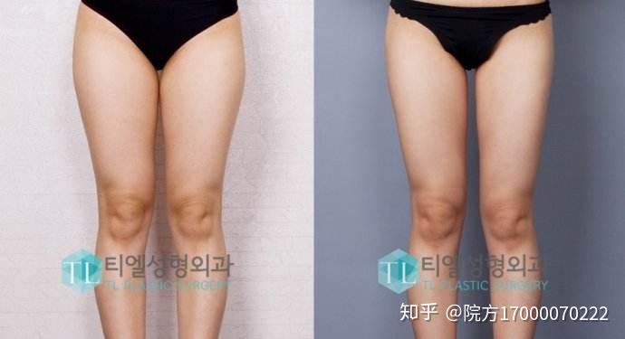 小腿减肥吸脂，塑造纤细美腿的有效方法