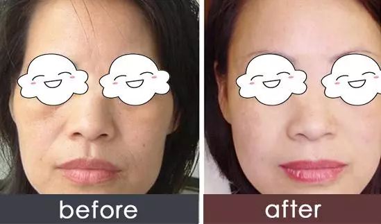 自体脂肪面部填充术，重塑面部轮廓的美学革命