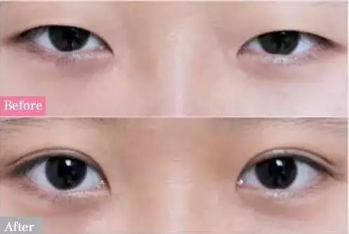 韩式三点双眼皮手术，重塑美丽双眸的秘密武器