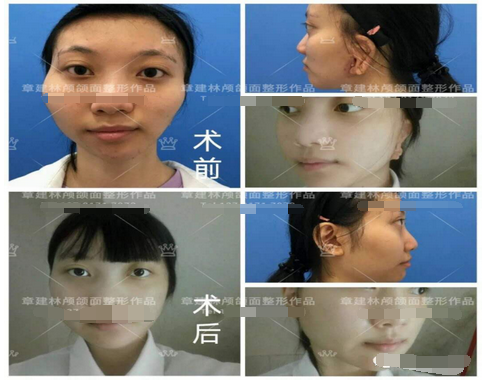 下巴整形，重塑面部轮廓的艺术与科学