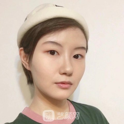 整容垫下巴，重塑自信，展现美丽新面貌