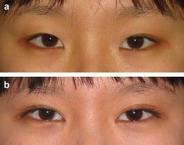 双眼皮塑造