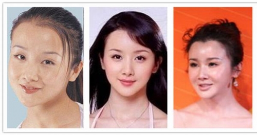 孙菲菲整容前后，变化与挑战