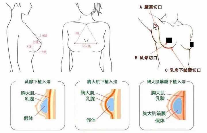 美容丰胸，重塑女性魅力的秘密武器
