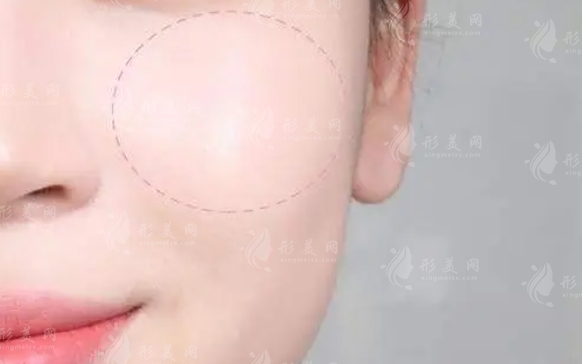 自体脂肪填充苹果肌，重塑面部轮廓的美丽秘诀
