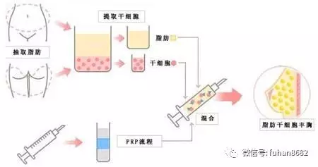 注射溶脂针减肥，一种新型的减肥方式