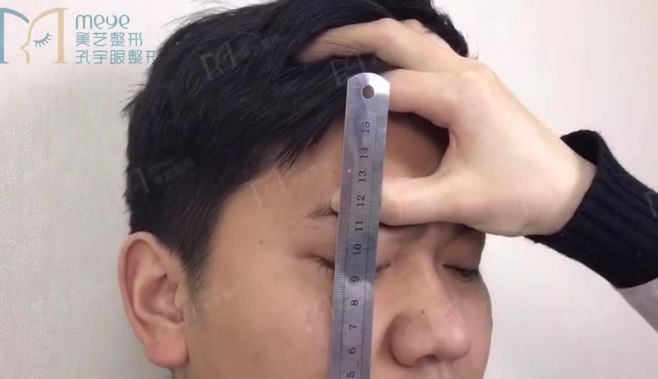 埋线法双眼皮，重塑美丽眼睛的时尚之选
