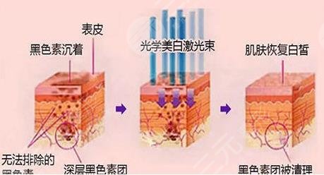 揭秘光子嫩肤价格，了解光子嫩肤一次多少钱
