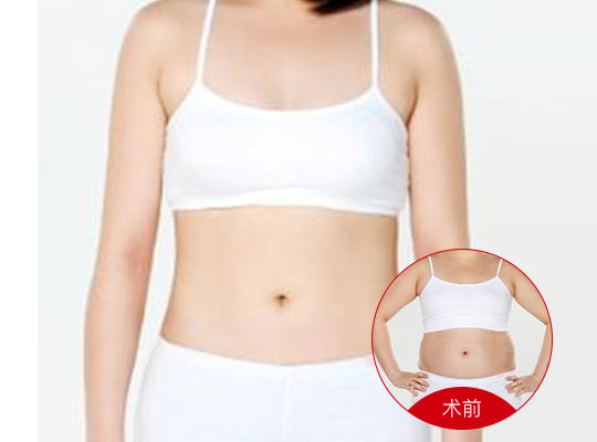 吸脂瘦身，探索现代瘦身新方式
