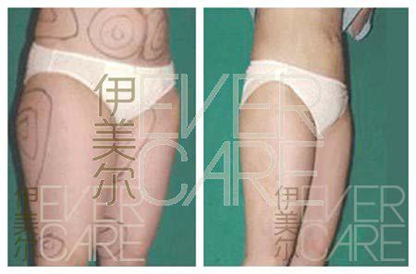 大腿吸脂减肥，探索有效塑形新途径