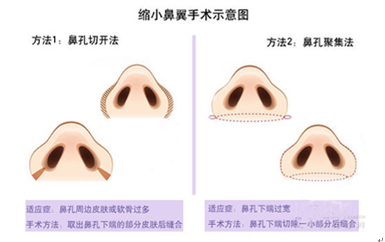 鼻翼缩小术费用详解，了解手术费用背后的因素