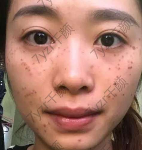 激光祛斑的危害与效果探讨