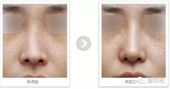 隆鼻恢复时间，全面解析与指导