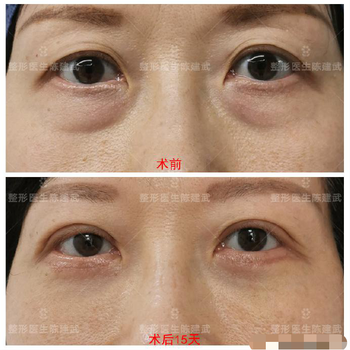 双眼皮手术