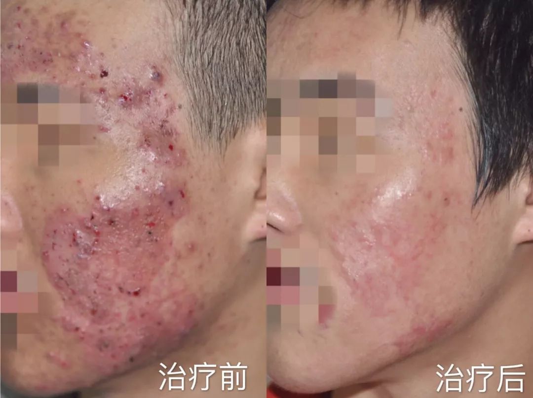激光治痤疮的费用分析