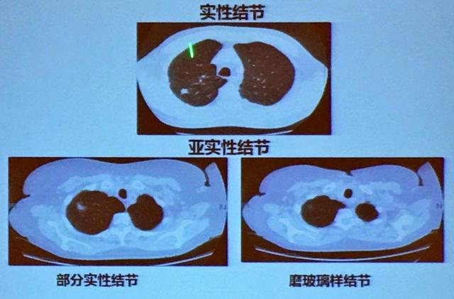 关于北京科兴与肺结节的真相探究